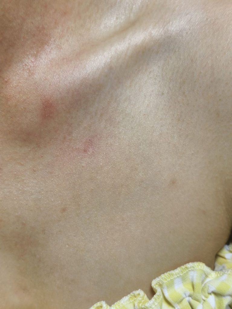锁骨 · 清洗4次后，术后图